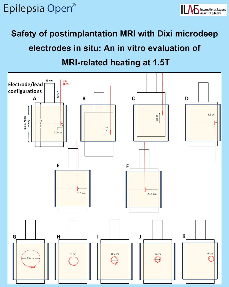 EpilepsiaOpen's tweet photo. SEEG depth electrodes can heat dangerously during MRI, and different electrode contacts can show large differences in heating. 
https://t.co/Sbi7OQiQ2l

#Epilepsy #ILAE #epilepsiaopen #icEEG #MRIsafety #RFheating #SAR #SEEG https://t.co/oqNvrPfk3X