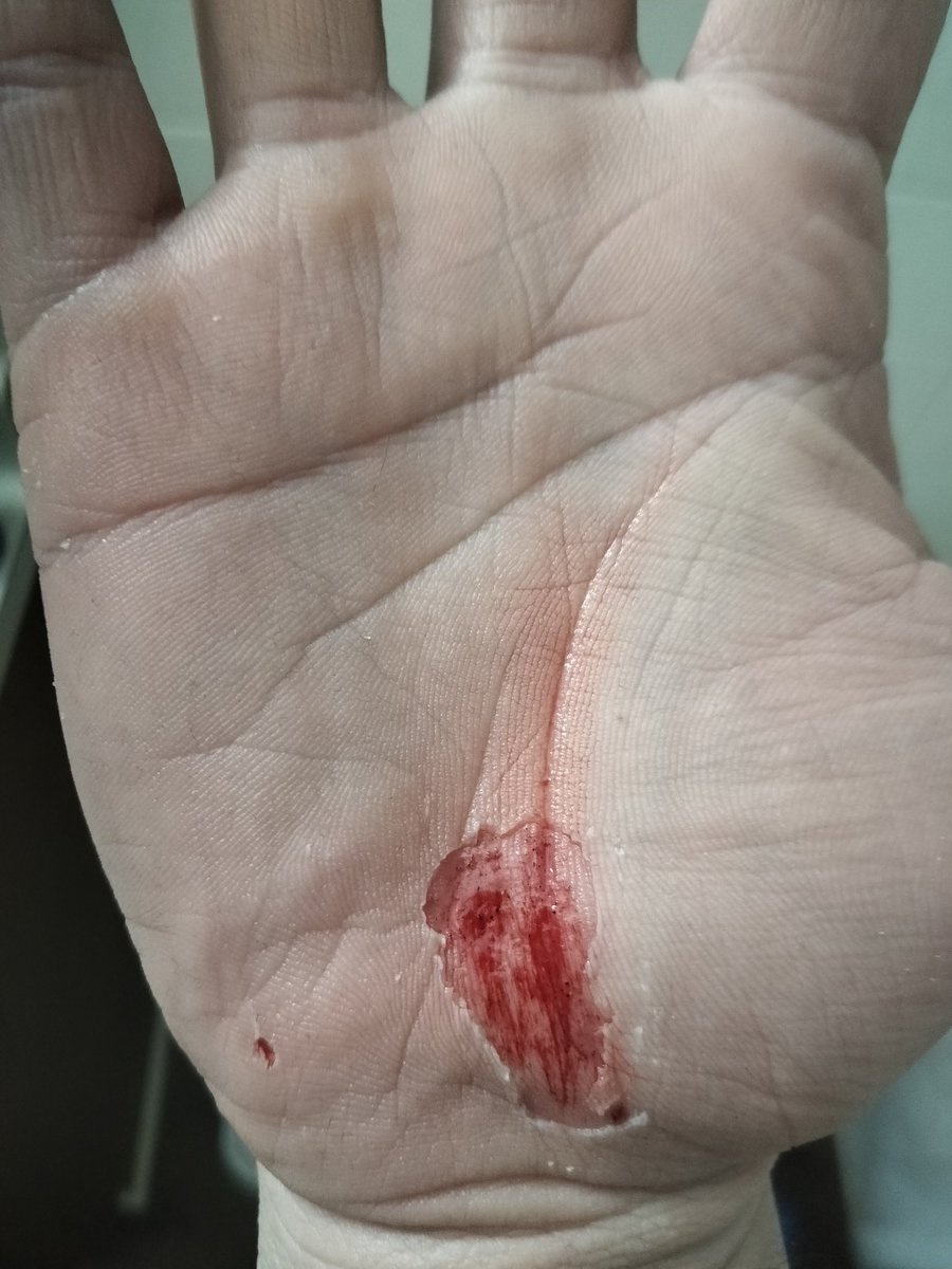 Lonewolf0584's tweet photo. I fell off my scooter today. Man that hurt like hell. Sight. Got some crazy injuries. But I am fine now. Except I got nothing to help cover these wounds. All I can do is wait for it to heal. 😭. But I am a tough guy. 💪. And be streaming later. https://t.co/2hr1aaFBAT
