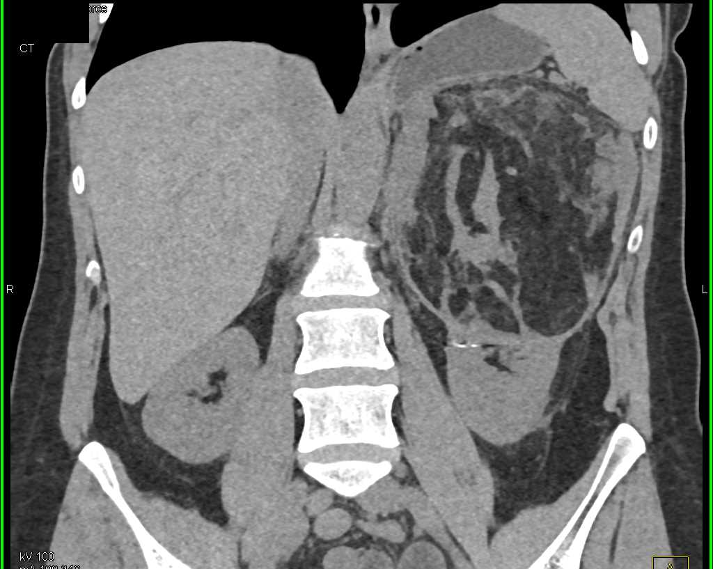 Elliot K Fishman / CTisus.com tweet media