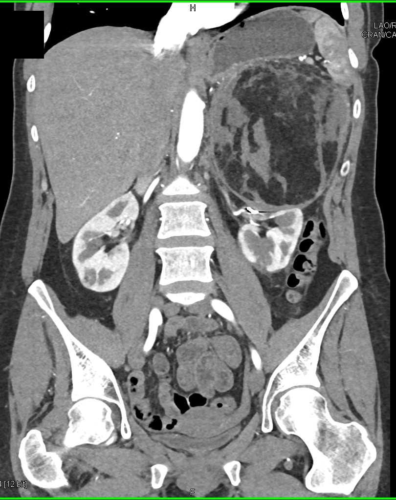 Elliot K Fishman / CTisus.com tweet media