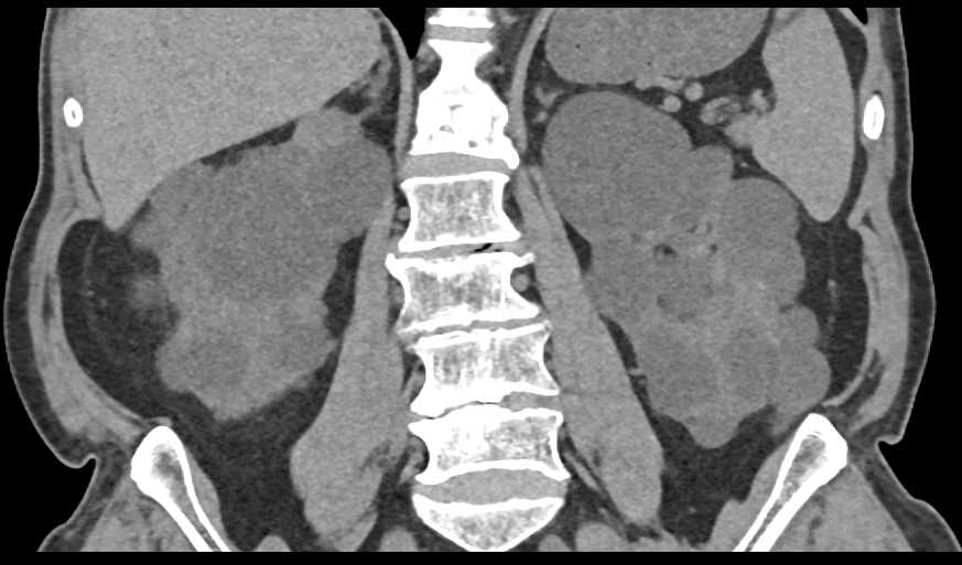 Elliot K Fishman / CTisus.com tweet media