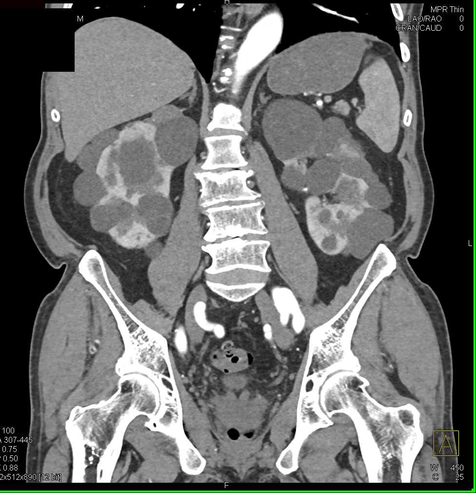 Elliot K Fishman / CTisus.com tweet media