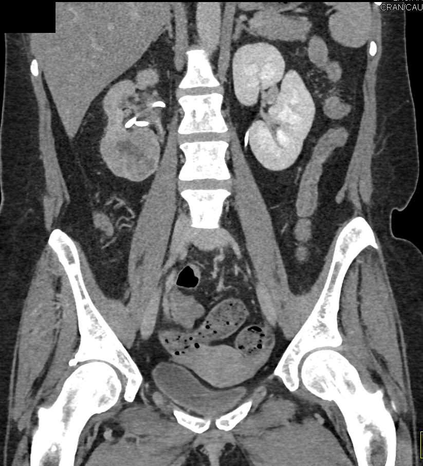 Elliot K Fishman / CTisus.com tweet media