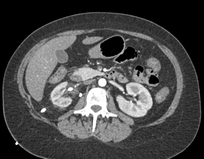 Elliot K Fishman / CTisus.com tweet media