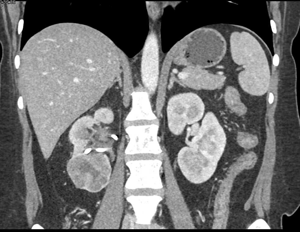 Elliot K Fishman / CTisus.com tweet media