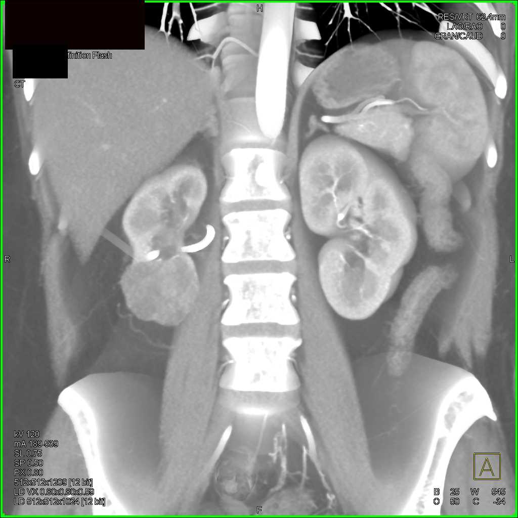 Elliot K Fishman / CTisus.com tweet media