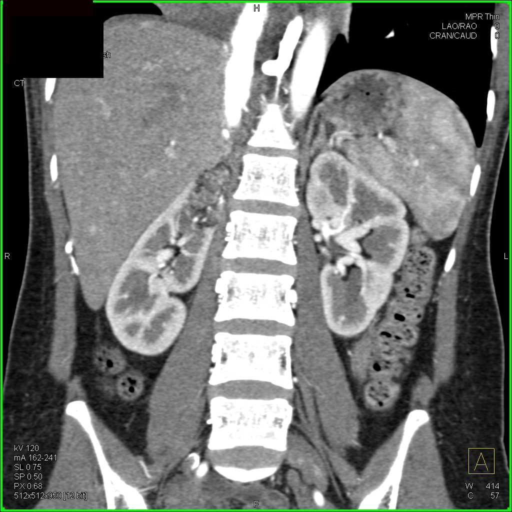 Elliot K Fishman / CTisus.com tweet media