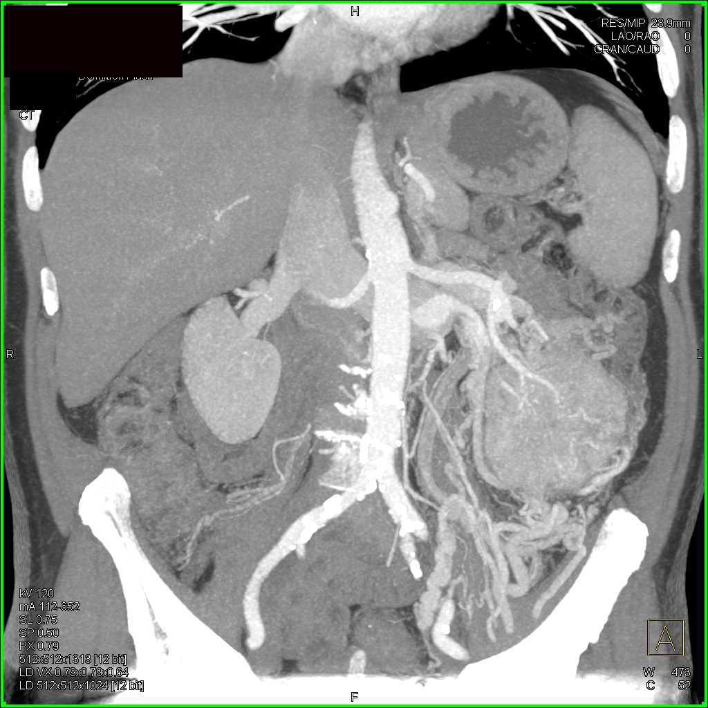 Elliot K Fishman / CTisus.com tweet media