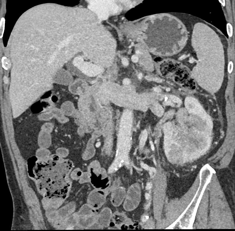 Elliot K Fishman / CTisus.com tweet media