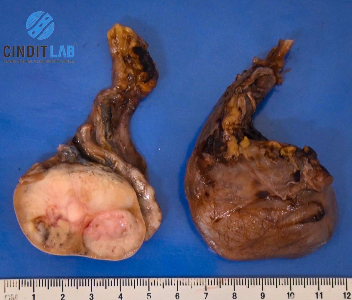 md_castaneda23's tweet photo. Neoplasia germinal maligna conpatible con seminoma puro.
Masculino de 25 años de edad.
#pathologylab #cinditlab https://t.co/B9E74q8oXS