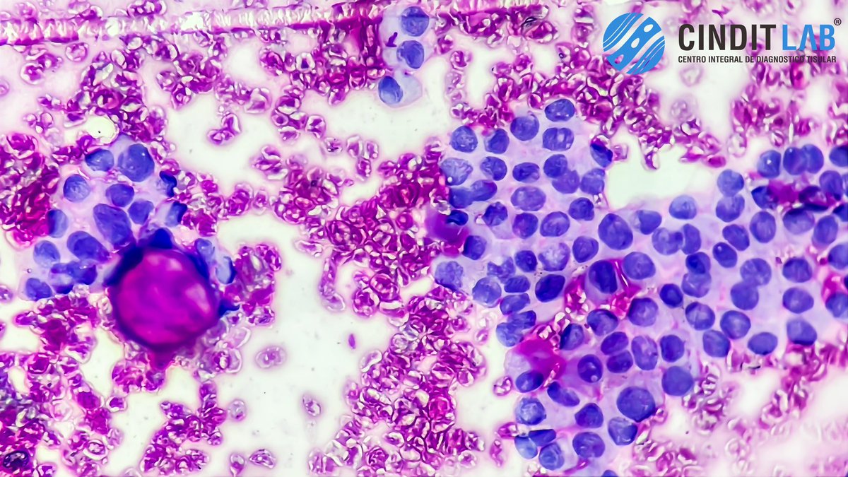 md_castaneda23's tweet photo. BAAF DE TIROIDES
Carcinoma Papilar de Tiroides
Clasificación Bethesda VI
#cinditlab https://t.co/xn9qjJpFyT