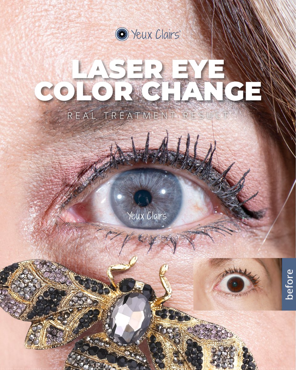 The hive mind approves! 🐝✨

More results: yeuxclairs.com/gallery
#LaserEyeColorChange #PermanentResults #SafeAndPainless