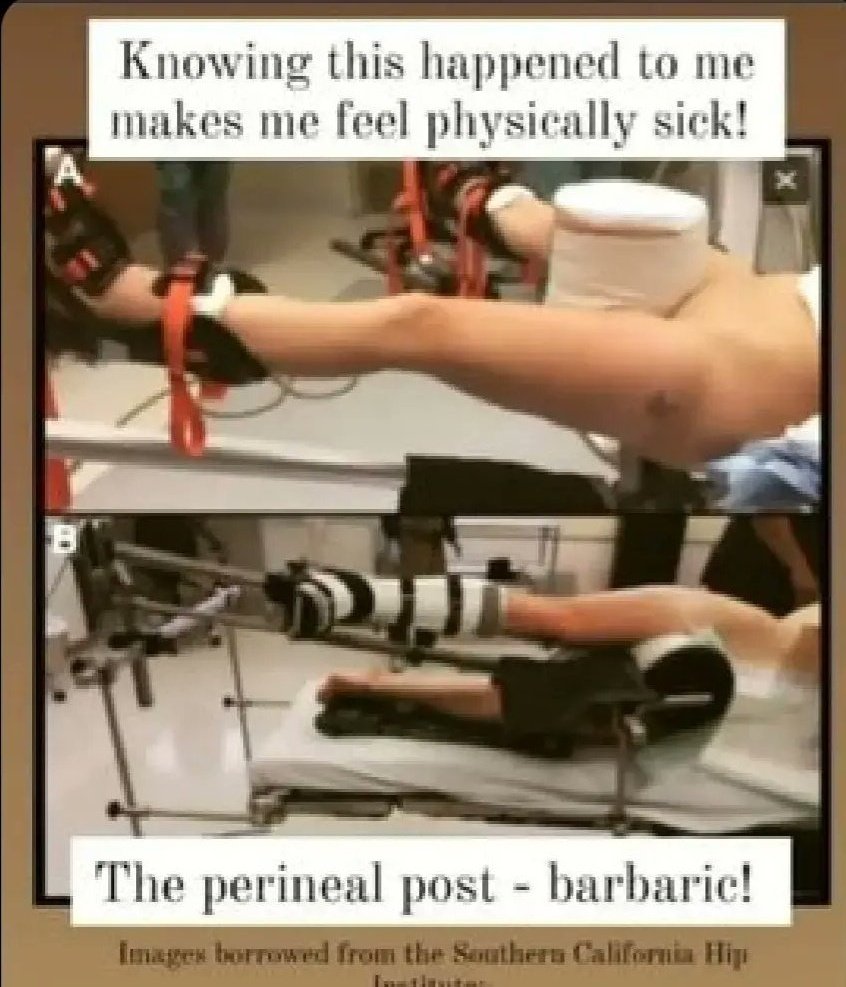 myfight2beheard's tweet photo. After denying me #InformedConsent and causing devastating permanent sexual dysfunction. During my complaint, my hip surgeon gloated that intimate crush and nerve injury was a known risk. He called it 'misfortunate' and stated he would 'consider' warning future patients.

#BanThePerinealPost
#DeniedInformedConsent
#NeedlessleyHarmed
#MedicalAssault