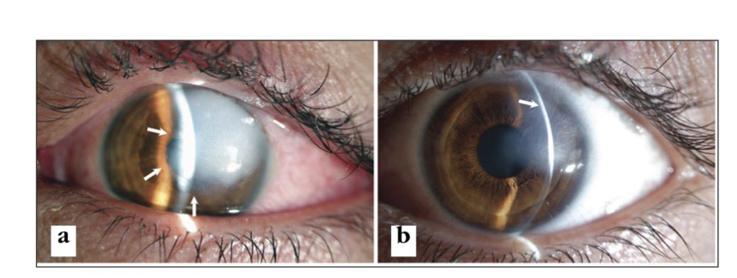 EMOSI BANGET LIATNYA!!

Tau gak kalo bara puntung rokok itu kena mata bisa menyebabkan kerusakan serius di mata?!

IYA MATA!
Bayangin ada orang lain yang penglihatannya bermasalah, bahkan seumur hidup karena gaya-gayaan merokok sambil naik kendaraan!

GAK PERCAYA BISA MERUSAK