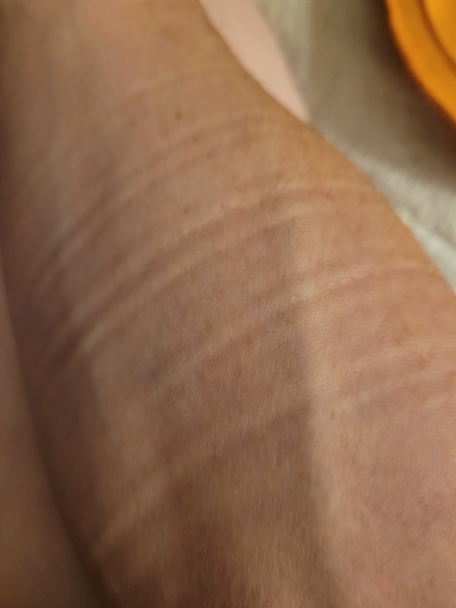 Apparently I have big forearms. I wear long sleeve compression shirts sometimes, and theysqueezethe hell out of my forearms.  My biceps don't get this kind of squeeze.

I need to eat some trenbalona sandwiches so they match 😋