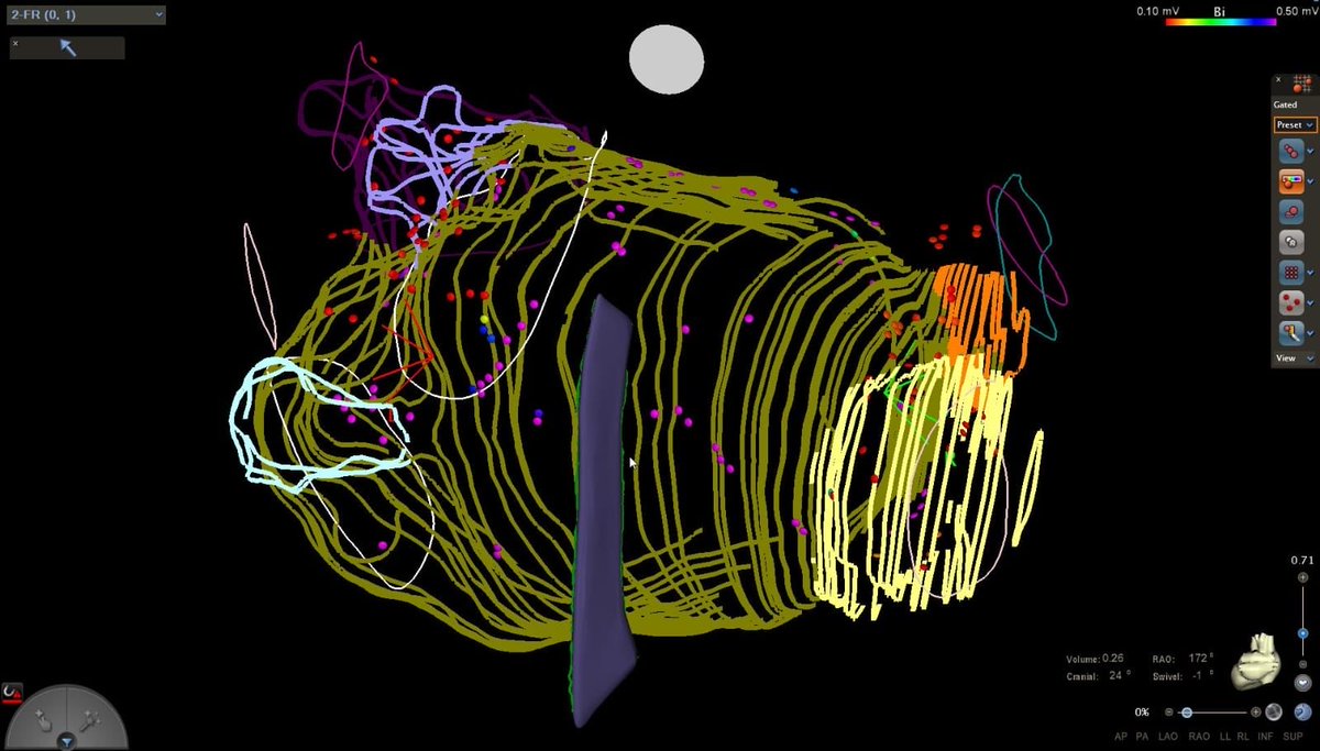 MagliariRafael's tweet photo. Sometimes EP mapping looks like abstract art.

#soundfan #ice #carto #atrialfibrillation https://t.co/hJEdexud27
