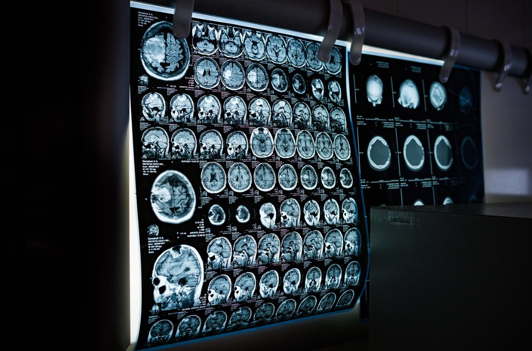 CT2023journal's tweet photo. AI is revolutionizing CT scans, delivering clearer images with less radiation exposure than traditional methods. Overcoming current limitations could make low-dose, high-quality imaging standard in hospitals worldwide.🧐
#AI #CT 
@CT2023journal 
https://t.co/1PhFwYlO3C https://t.co/0fYRpnL1m5