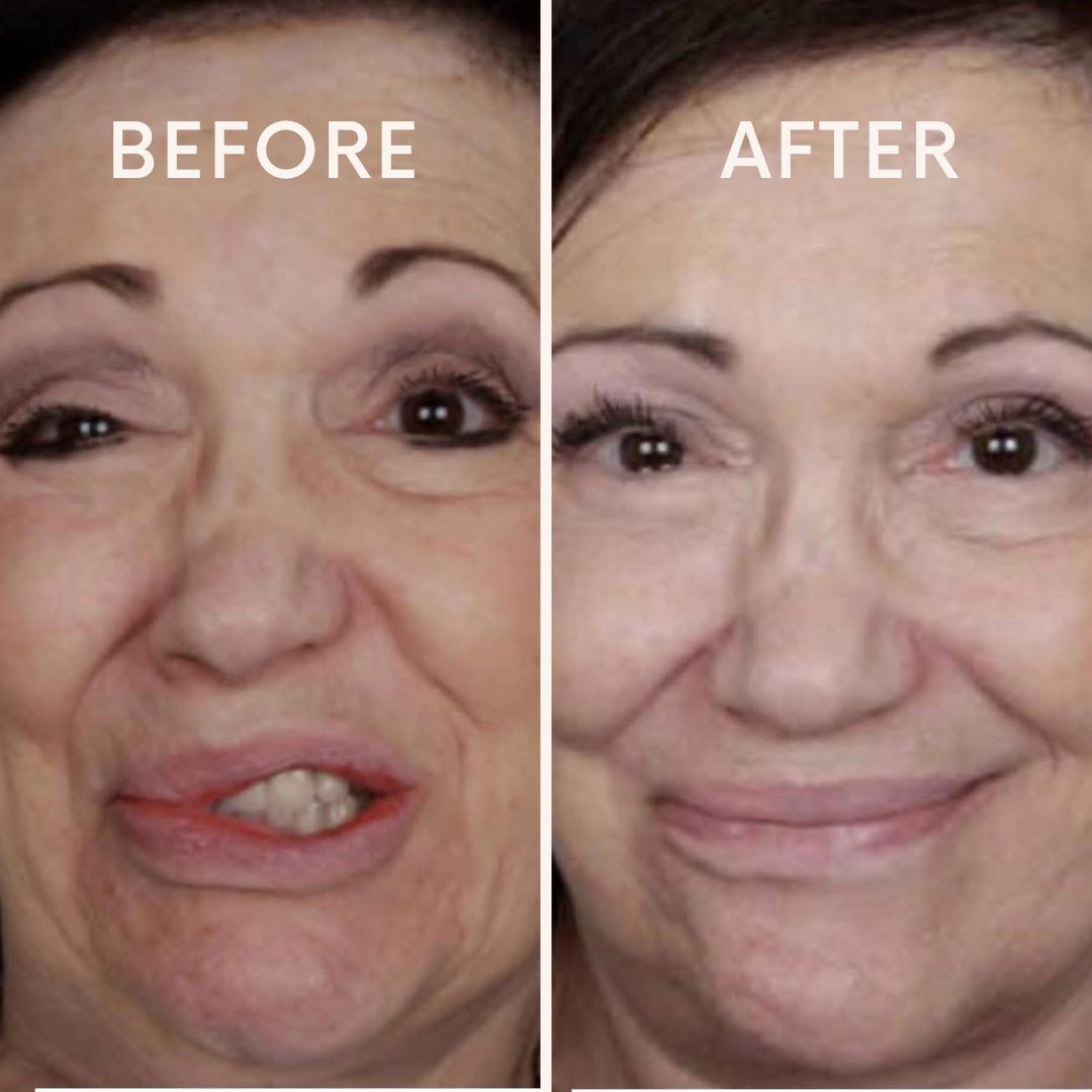 New York Facial Paralysis tweet media
