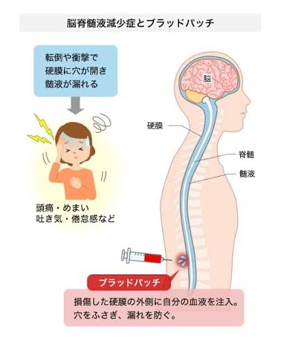 TFOA_wt's tweet photo. 公明党ヤバいな

俳優の米倉涼子さんも苦しんだ
「脳脊髄液減少症」。
かつては「気のせい」とまで言われたこの病気の治療（ブラッドパッチ）を、10年以上かけて保険適用まで持っていったのが古屋範子さん。

25万人の署名を抱えて国を動かした執念がマジでレベチ。
この人がいなきゃ救われなかった人、
日本中に絶対にいるはず