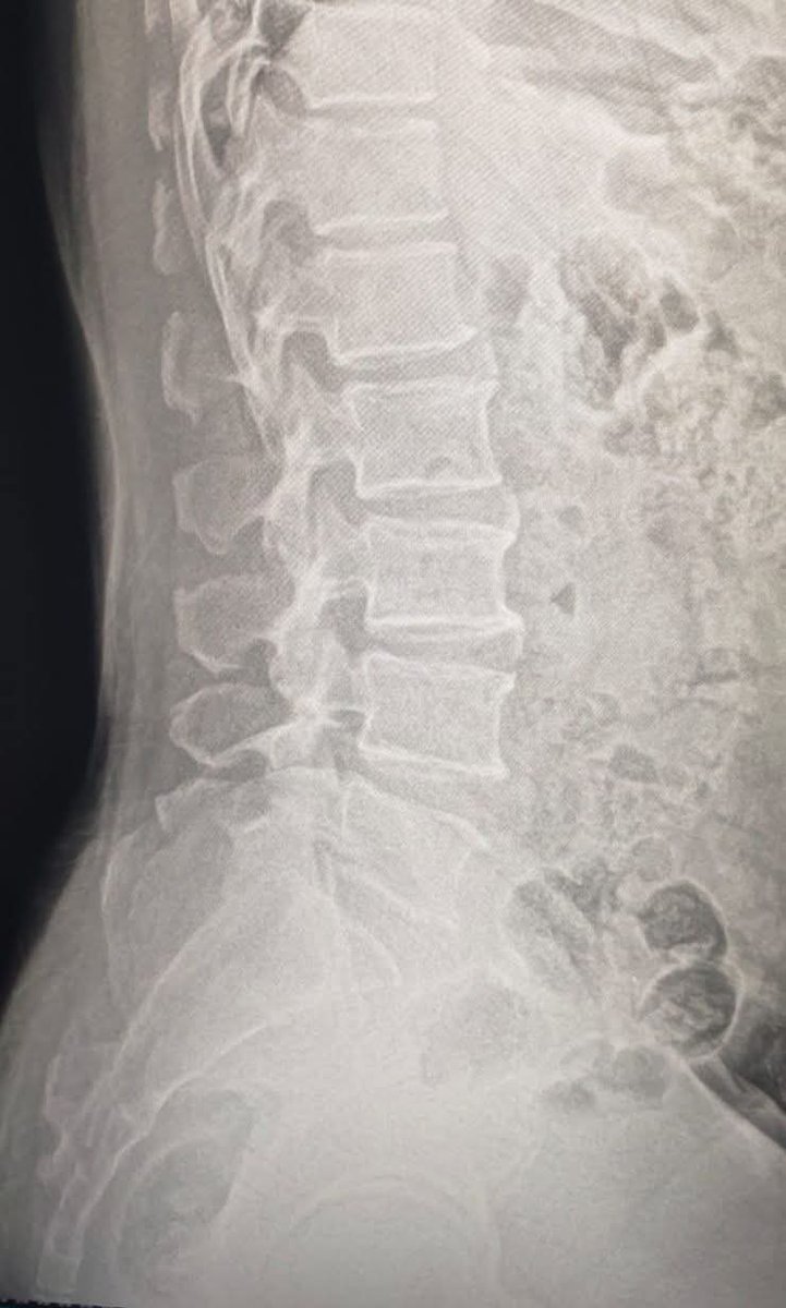 albertoortegana's tweet image. History :: Back Pain 
What's Ur diagnosis ⁉️ 
#xray #orthopedics #radiology #lumberspine #diagnostics 
@dr_manish_ydv @Dr_Shiv_kumar_ @DrAkhilX @DrMedica_13 @hemo_shk @drobiy12 @DrsansariOrd