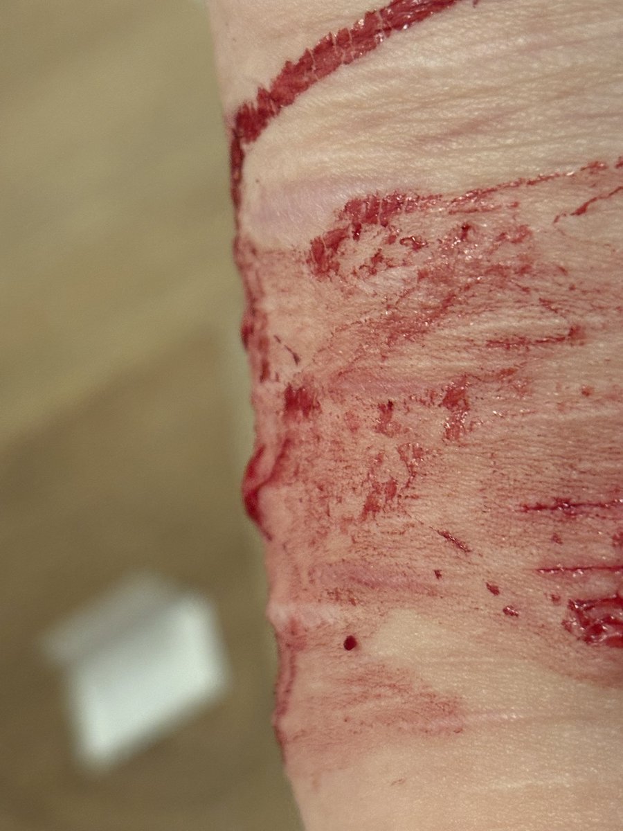 ayami___000's tweet photo. It’s kind of sad how little blood it is
But I’ve managed to cut open my Keloid scars
It seems yellow inside? 
I wish I could cut deeper, but I’m too weak.
#shtwt https://t.co/d0n1w6XbjZ