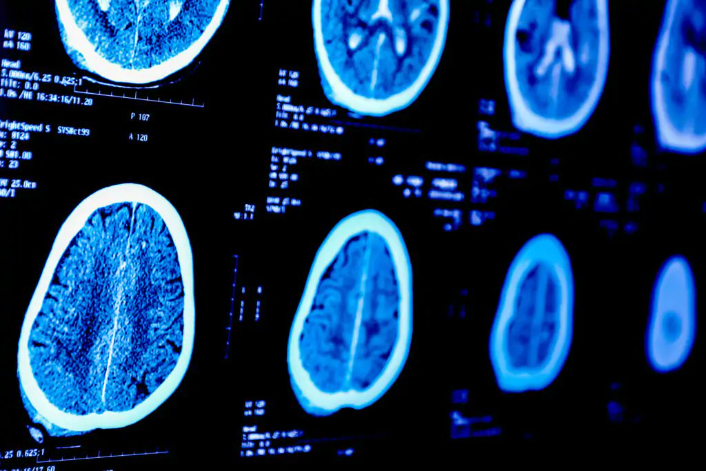 🇫🇷🧠 FLASH | Avancée majeure contre la maladie d’Alzheimer : des chercheurs français ont IDENTIFIÉ un nouveau mécanisme impliqué dans son développement.

Ils montrent pour la première fois le rôle clé des cellules appelées tanycytes, chargées d’évacuer la protéine Tau du cerveau.