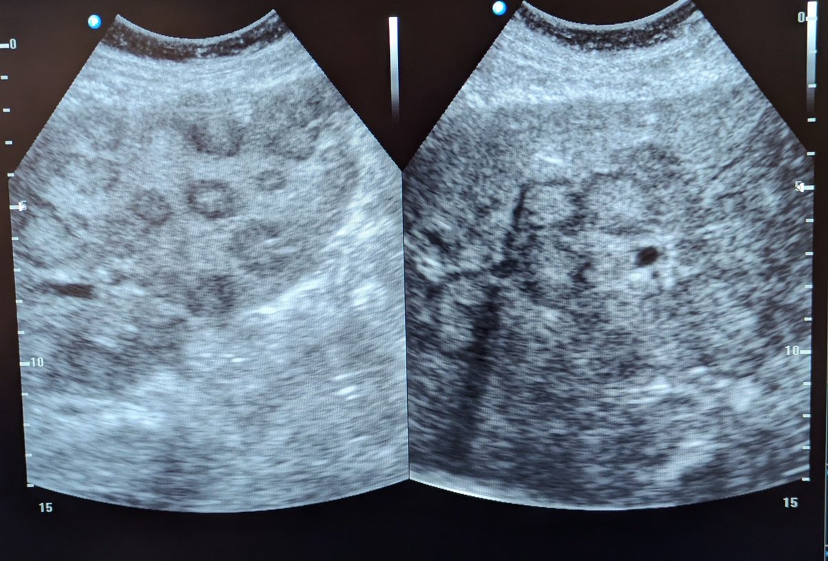 Ru Q Elderly woman with RUQ pain and frequent vomiting.