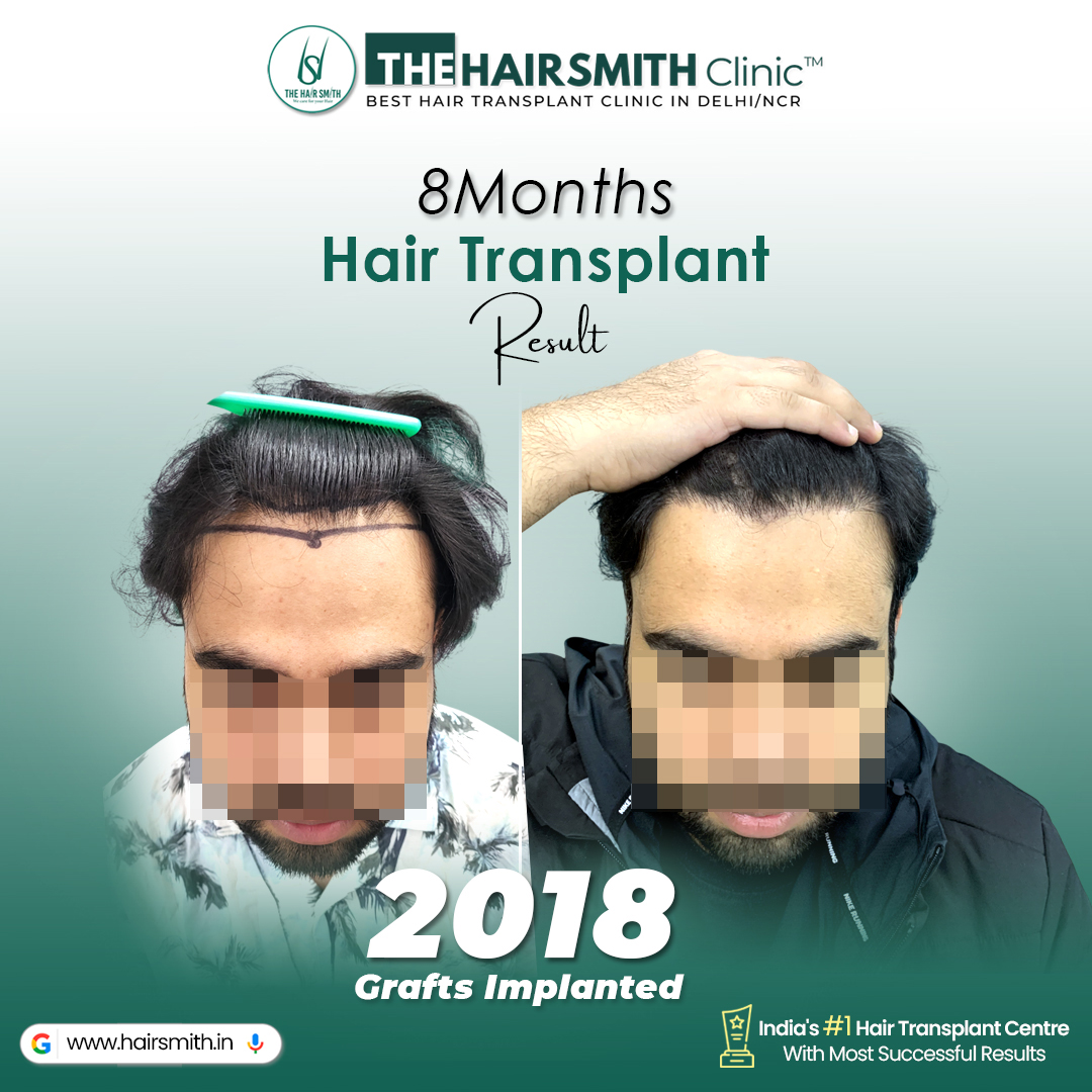 TheHairsmith's tweet photo. Receding Hairline → Full Hair Transformation in 8 Months 🔥

Real Hair Transplant Before &amp; After Result using Advanced UR-FUE Technique at The Hairsmith Clinic – Best Hair Transplant Clinic in Delhi NCR, India.

Thinking about getting a hair transplant?
🕻 +91 9999481878/98 https://t.co/5aHU7YQ35Y