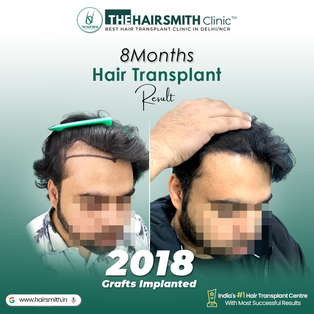 TheHairsmith's tweet photo. Receding Hairline → Full Hair Transformation in 8 Months 🔥

Real Hair Transplant Before &amp; After Result using Advanced UR-FUE Technique at The Hairsmith Clinic – Best Hair Transplant Clinic in Delhi NCR, India.

Thinking about getting a hair transplant?
🕻 +91 9999481878/98 https://t.co/5aHU7YQ35Y