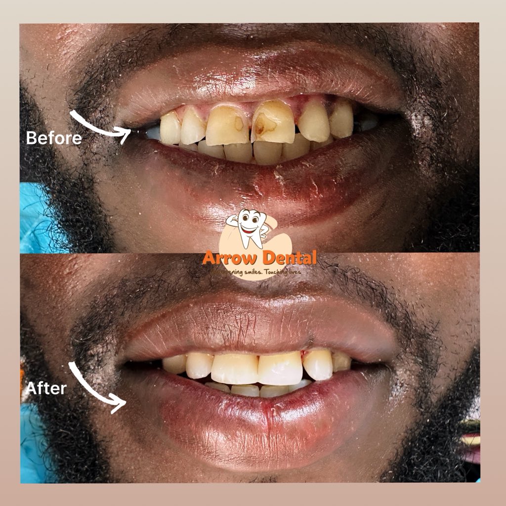 2 teeth. One morning. Major difference. ✔️

Sometimes a small change is all it takes to transform a smile.

Try the <a href="/Arrow_Dental/">Arrow Dental Centre</a> touch today. 🦷

💳 We accept insurance
📍 Karibu 

📲0769899516 | 0740187579