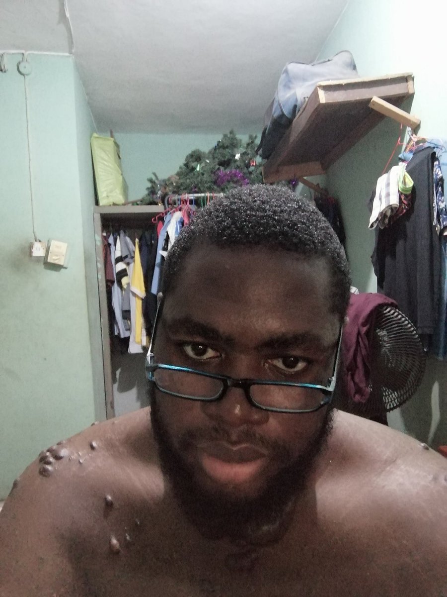 derapeterssss's tweet photo. So this month is keloid awareness month and its a good time to be proud of your scars and keloids. Don’t feel bad cos we don’t have control over its growth, so show your keloids today!! 

Happy Keloid Awareness Month yall https://t.co/r80e5F2pYn