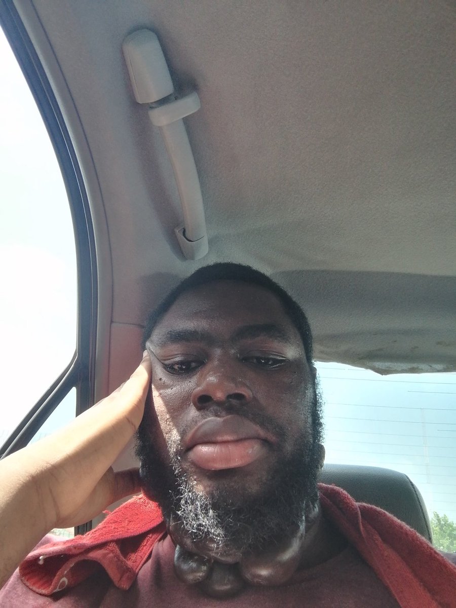 derapeterssss's tweet photo. So this month is keloid awareness month and its a good time to be proud of your scars and keloids. Don’t feel bad cos we don’t have control over its growth, so show your keloids today!! 

Happy Keloid Awareness Month yall https://t.co/r80e5F2pYn