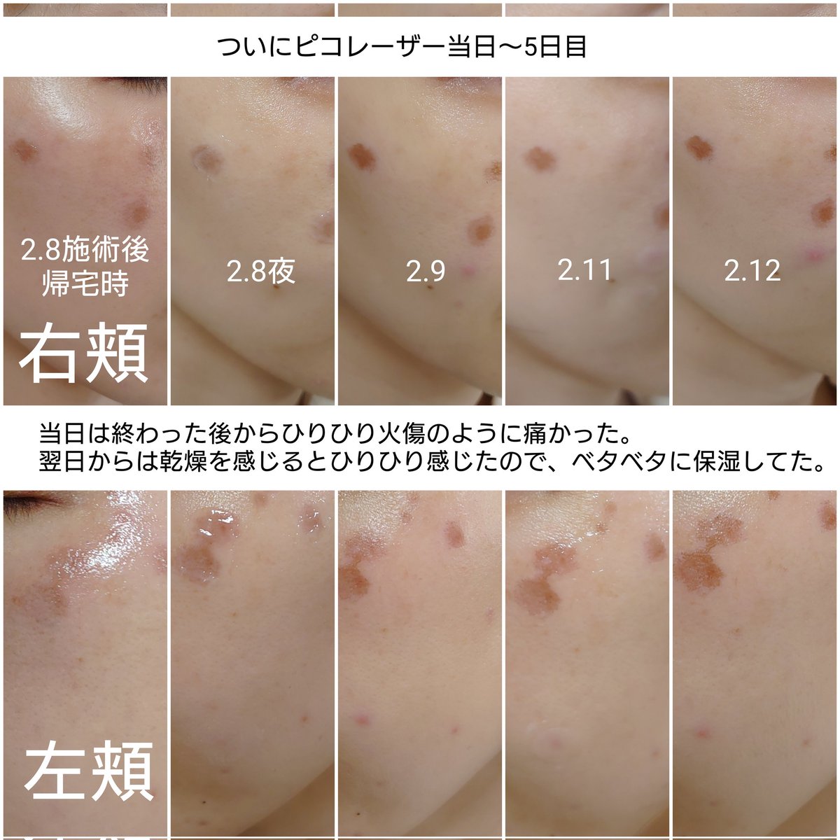 E7tceerQlJMf3hG's tweet photo. やっと完成させました。シミ取りの記録です📝
・トーニングは肌トーン明るくなる。
・シミはピコスポット後いったん濃くなってその後薄くなる。
・気にならなくなるまでは時間がかかる。
・予備軍からシミはまた出てくる。
その他レポはメモ書き程度ですが、リプにつなげてます。 https://t.co/0rktz2sEnT