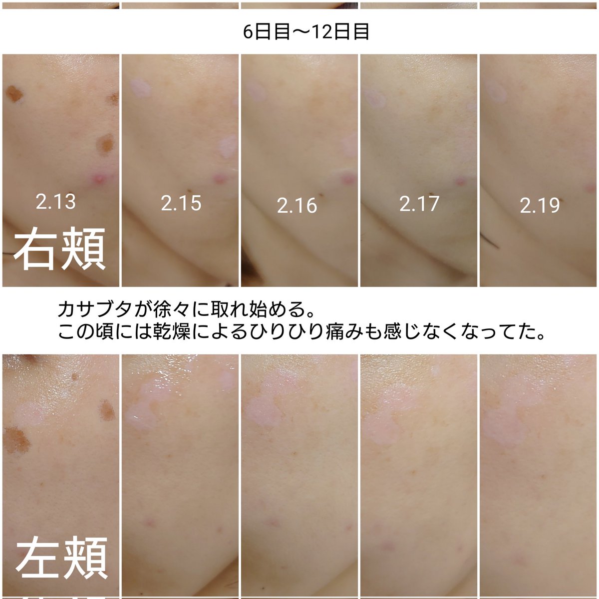 E7tceerQlJMf3hG's tweet photo. やっと完成させました。シミ取りの記録です📝
・トーニングは肌トーン明るくなる。
・シミはピコスポット後いったん濃くなってその後薄くなる。
・気にならなくなるまでは時間がかかる。
・予備軍からシミはまた出てくる。
その他レポはメモ書き程度ですが、リプにつなげてます。 https://t.co/0rktz2sEnT