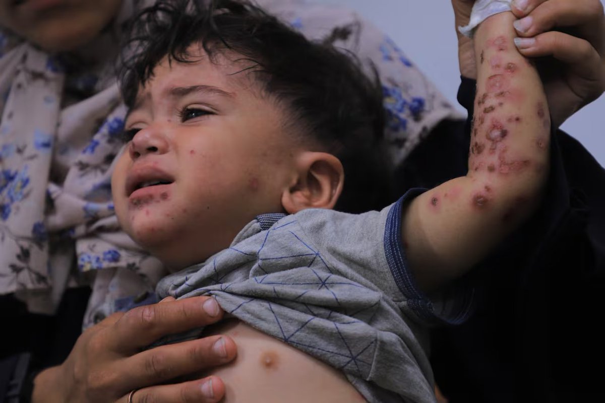 gazanotice's tweet photo. 🚨 @UNRWA reports a sharp rise in scabies, head lice, and waterborne diseases across Gaza's overcrowded displacement shelters. Deteriorated shelter materials and collapsed sewage networks are creating what health teams call a high-transmission environment. https://t.co/s8agG1LEqP