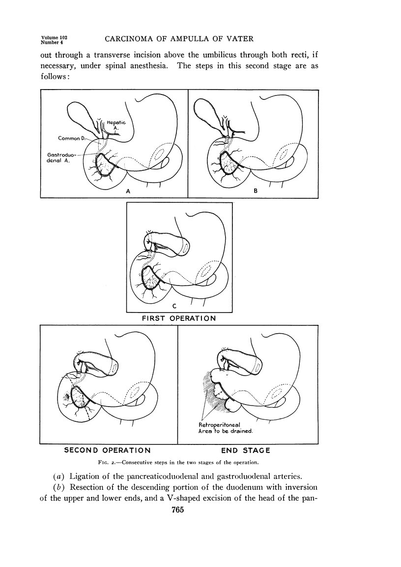 jdimick1's tweet photo. Surgical history that @AnnalsofSurgery is proud to have shared in! 

5 years before the first single stage, we published the two stage Whipple procedure. 

Full article is free on pub med central: Ann Surg. 1935 Oct;102(4):763–779. https://t.co/V6naEuCnmt