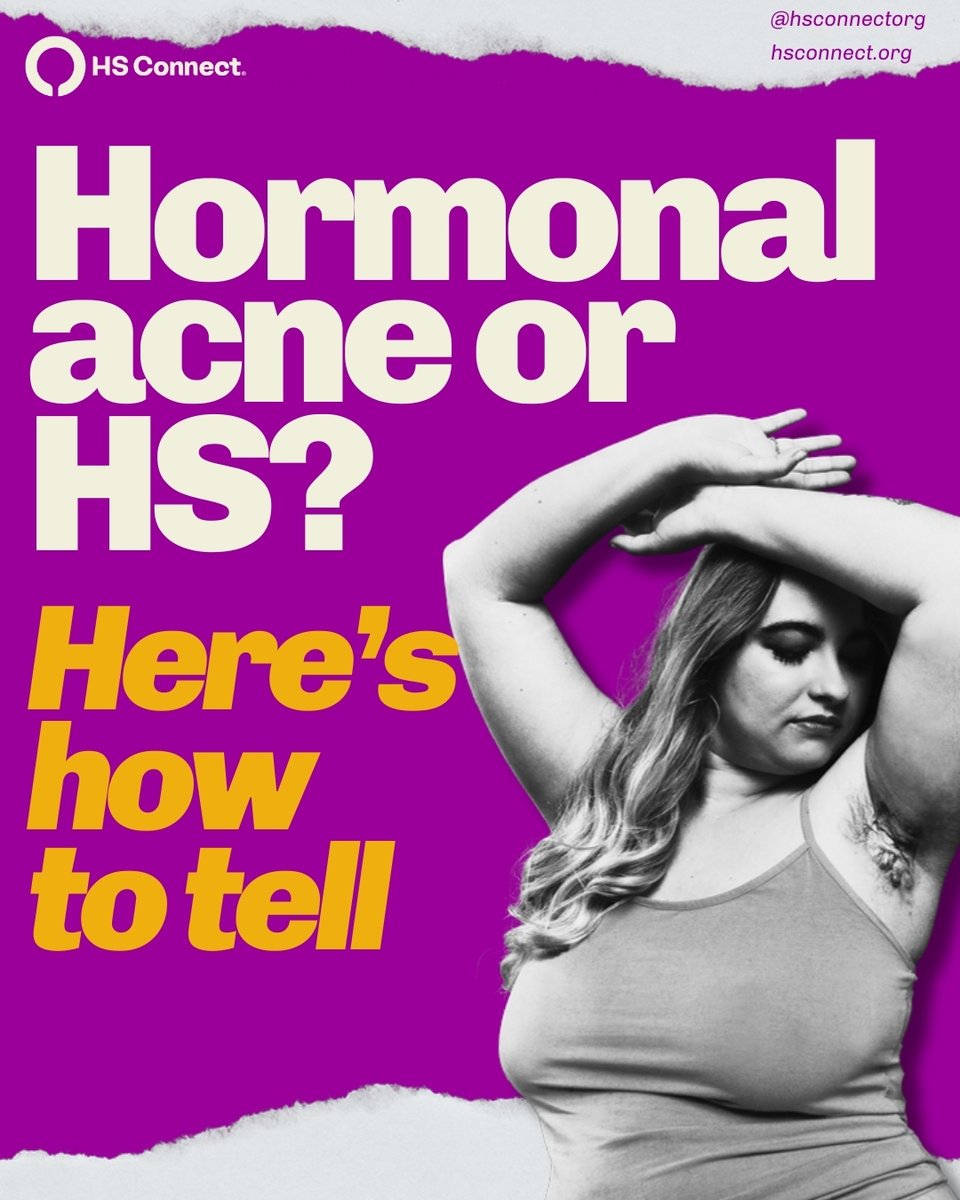 HSConnectOrg's tweet image. Hormonal acne or HS? 🔎💜

They may look alike, but they’re not the same, and knowing the difference can make all the difference in getting the care you deserve.

#HidradenitisSuppurativa #HSCare #HSCommunity #ChronicIllness #HSAwareness