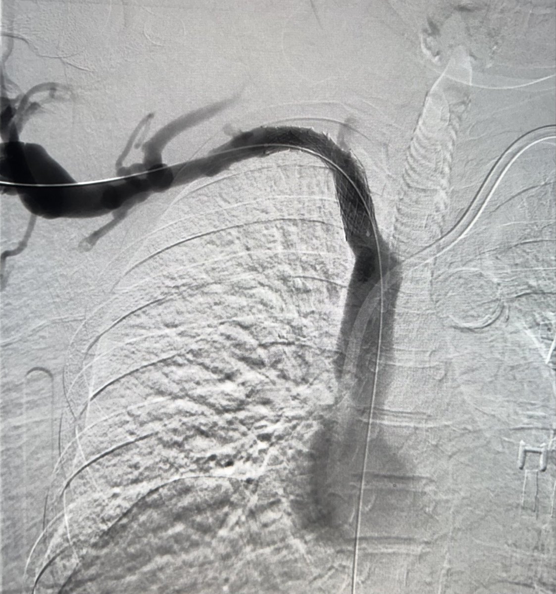 eliebalesh's tweet photo. ESRD on HD via RUE AVF with severe limb edema. Fistulagrams at Big Box AMC for “high venous pressures,” but deemed “well-collateralized.” Classic TOS. Referred for bony resection, then balloon venoplasty &amp; stenting (@Medtronic Abre), with restoration of brisk in-line flow. #IRad https://t.co/VRA4FMfjUH