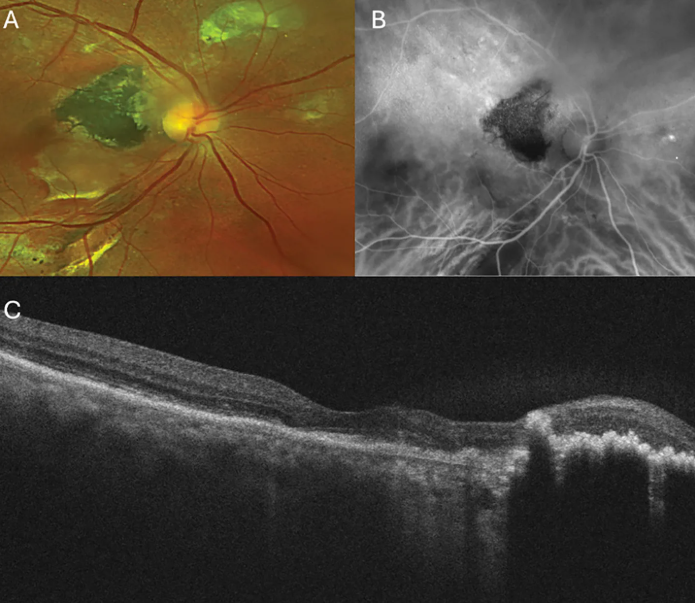 Retinal Physician tweet media