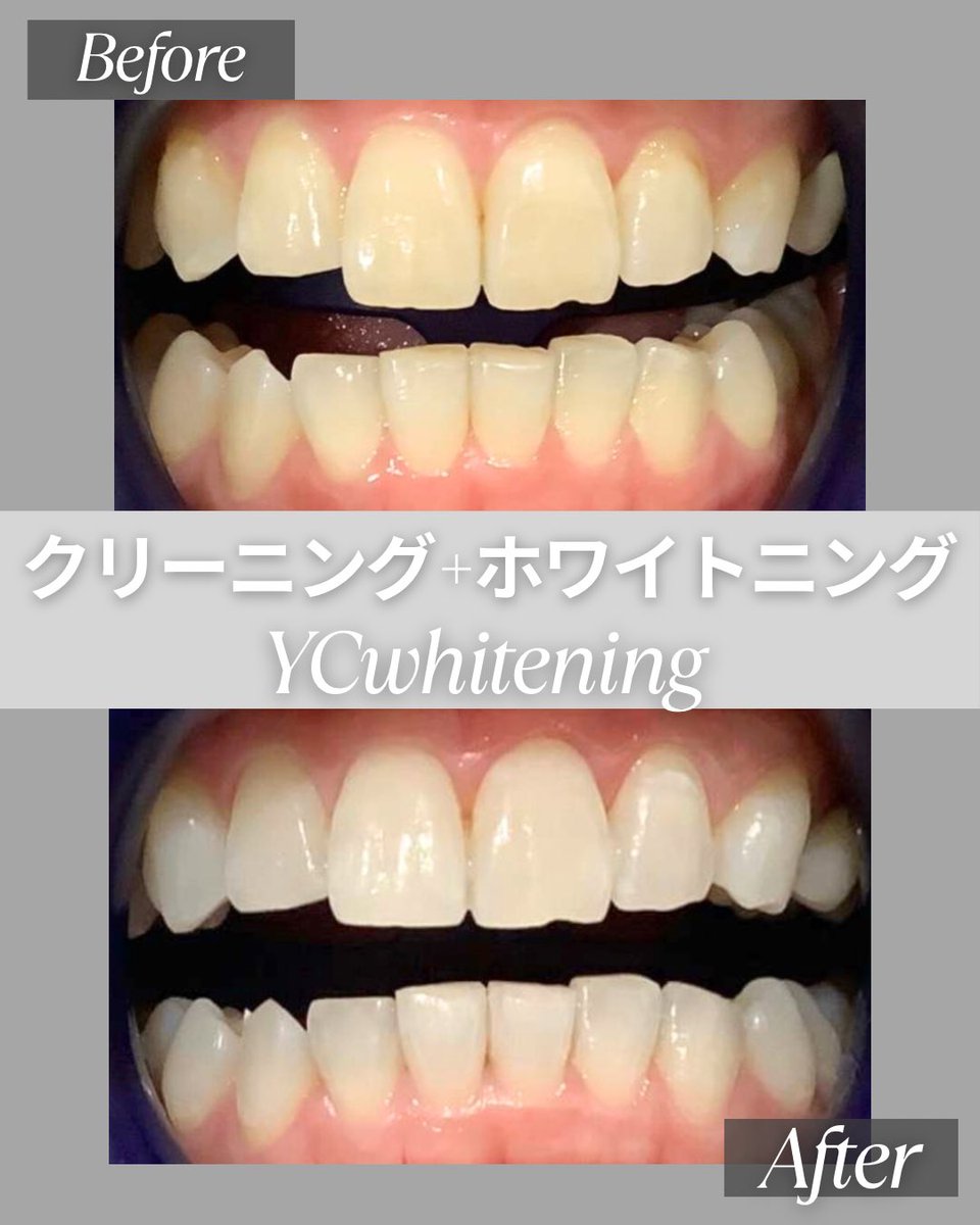 YCwhitening's tweet photo. 💎Before／After💎
【クリーニング＋ラグジュアリーホワイトニング】

ホワイトニング前にクリーニングで歯石や着色を落とすことで薬剤が浸透しやすくなり、ホワイトニングがより効果的になります✨
艶が出て、仕上がりも綺麗に！👏 https://t.co/hLCA208Acy