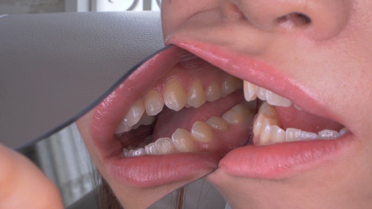 TicklingFriends's tweet photo. Let's all enjoy tickling.
美女の口内をじっくり観察するのもいいですね。
マスオープナーを入れた口がとてもエロと思います。
今日は、結羽ちゃんです。
※12枚のサンプル画像は↓下のURLをクリック！
https://t.co/vRDEbh24vw
@adoafechi
@abvakiba
#口内 #口腔り #歯 #歯茎 #舌ベロ #唾液 #反射鏡 https://t.co/XOKqDbwyIl