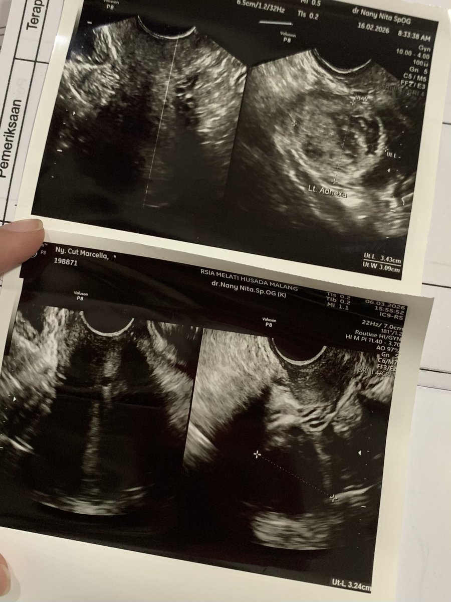 Mens teratur. Ga nyeri haid. Gaada gejala apa-apa tau tau kena kista ovarium 🥹

Makasih buat mbak2 di fyp tiktok yang sharing soal perut buncit yg kena kista 30 cm. Gara2 video itu lewat, aku tiba2 USG dan untungnya ketauan ada kista juga ukuran 3 cm tanpa gejala.

Doain lancar