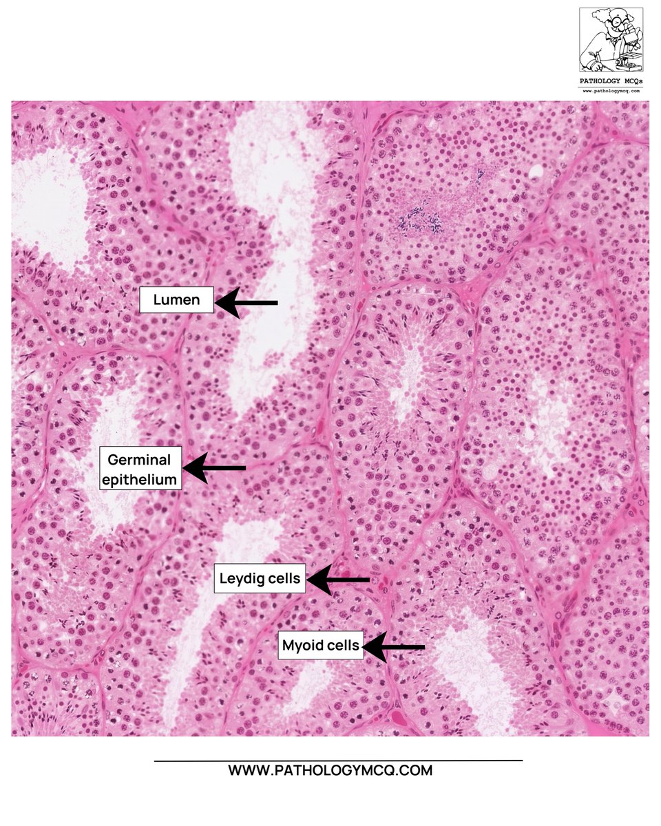 Pathology_mcqs's tweet photo. 🔬 Testicular biopsy: identifying the key cells

Inside the seminiferous tubules, spermatogenesis progresses in an orderly maturation from the basement membrane → lumen.

#Pathology #Histology #Testis #Spermatogenesis #PathologyPearls #MedicalEducation #NEETSS #FRCPath https://t.co/lQRhCNBE2b