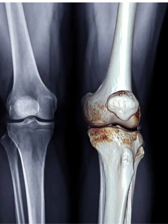 MarcoChangoS's tweet photo. ARTROSIS Y DOLOR CRÓNICO DE RODILLA 
MEDEPORT 
Dr. Marco Chango Médico Deportólogo especializado en la UFRGS Porto Alegre Brasil, IMD de la Habana Cuba y CAR de Barcelona España.
Monte Sinai Torre 2 4to piso.
WhatsApp 0987302477 https://t.co/8lax55uDAU