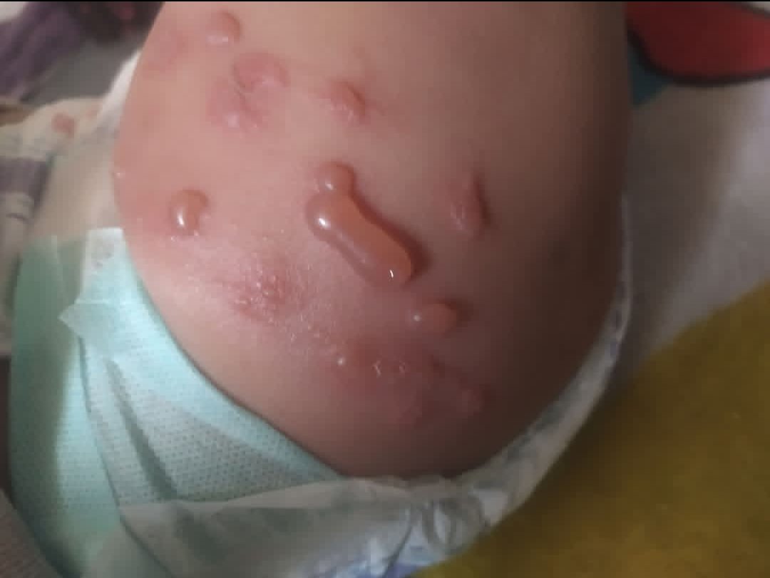 yousefQasem1998's tweet photo. WILL DIE😭 

Unfortunately, my poor little sister's body is full of pimples and I can't do anything for her. She urgently needs your help to provide tr

3 replies — even dots — can break the
 algorithm 😭 
@ireallyhateyou
@iwasnevrhere_
@NateB_Panic

https://t.co/hR7oM0tumZ https://t.co/EmfdLCbWHF