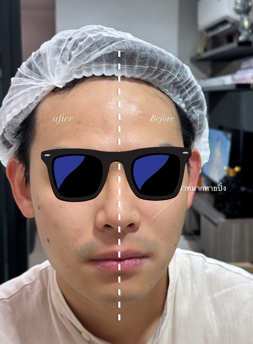 codekungz's tweet photo. คหสต.หัตถการใบหน้าที่รู้สึกว่าคุ้มค่าที่สุดคือโปรแกรม Ultraformer III นี่แหละ 6 เดือนทำทีนึง ชอบสุดคือมันไม่เจ็บ ไม่มีเข็มจิ้มอะไรเลย แต่ผลลัพธ์สู้ botox filler ได้อยู่ โดยเฉพาะผู้ชายที่ไม่ได้ต้องการชัดมาก แต่อยากให้หน้าดูกระชับ ดูเด็กลงคือเห็นผลแน่ๆ 😳 https://t.co/RE2qqzSAb9