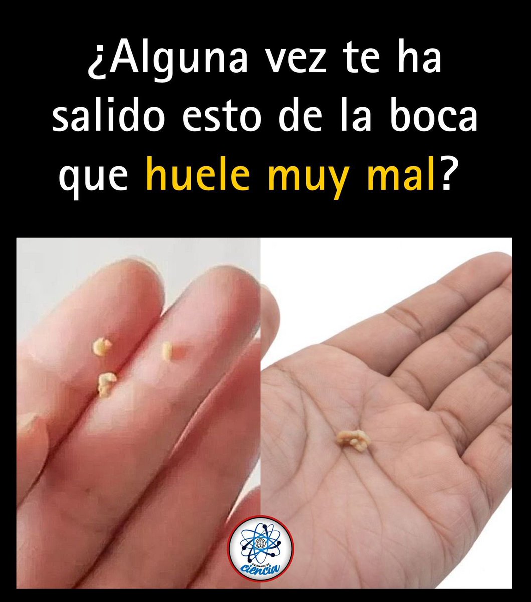 EnsedeCiencia's tweet photo. 🚨 Si estornudas varias veces seguidas y luego sientes cosquillas en la garganta, podría ser algo que muchos tienen… pero pocos conocen; su nombre, tonsilolitos. 

Aprende todo lo que debes saber de ellos y cómo eliminarlos.👇 https://t.co/XwrBMKaLog