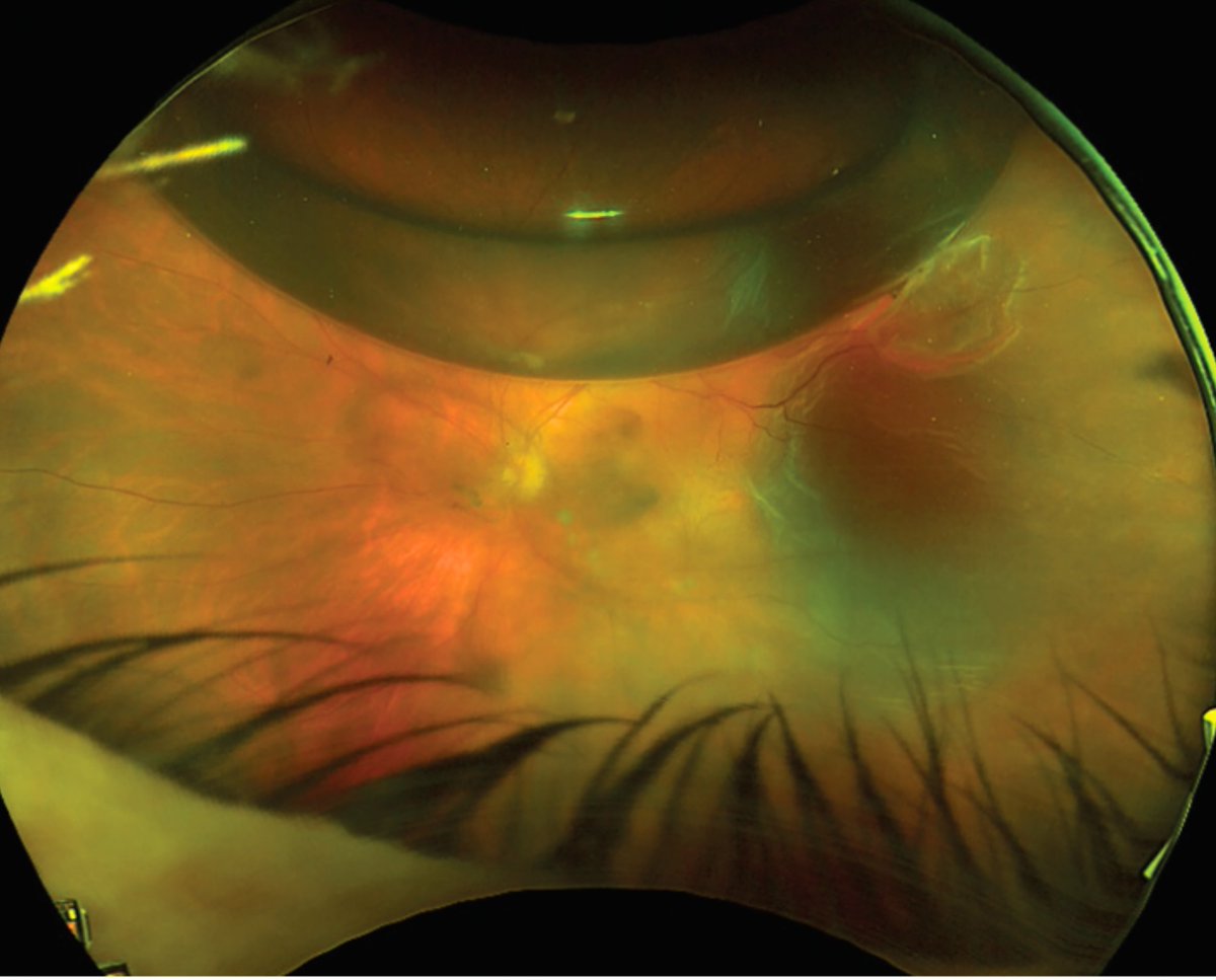 Retina Specialist tweet media