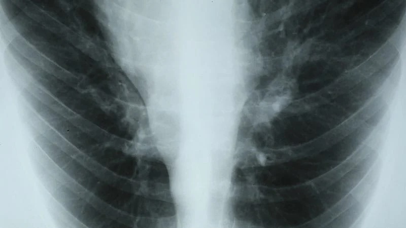 Aller_MD's tweet photo. Adults with severe #asthma were more likely to discontinue #biologic #therapy based on nonclinical reasons than based on #side #effects or #ineffectiveness, according to data from more than 7000 individuals presented at the #AAAAI 2026 Annual Meeting. https://t.co/NUwBvsYjY8 https://t.co/zTOLAG1JnE
