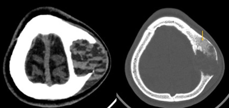 This week’s SPIN-POV: Always inspect the surrounding bone when ...